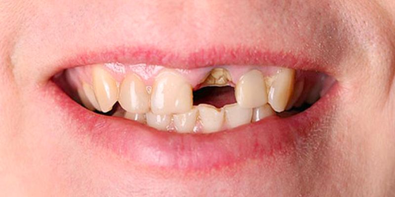 Mơ thấy rụng răng không chảy máu có thường gặp không?
